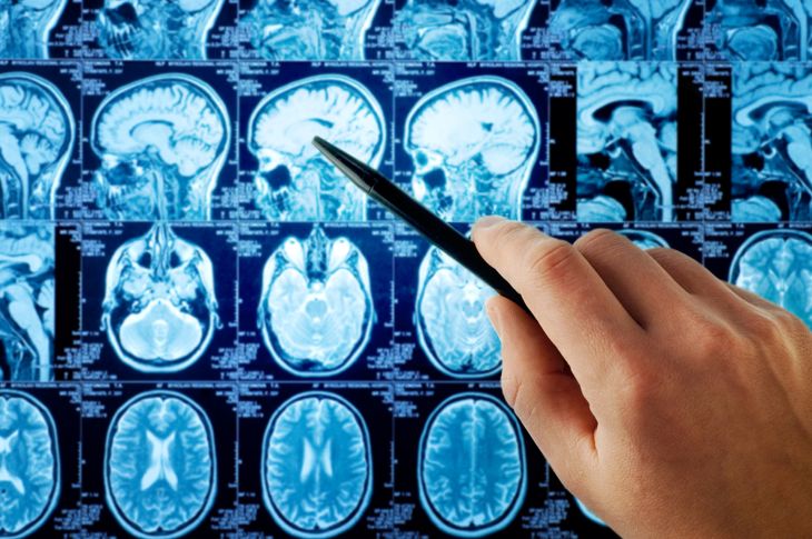 10 Signs of a Brain Tumor