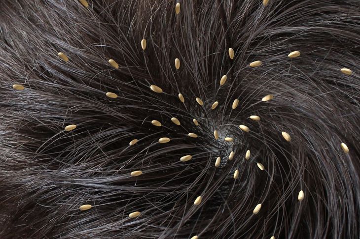 10 Signs of Head Lice