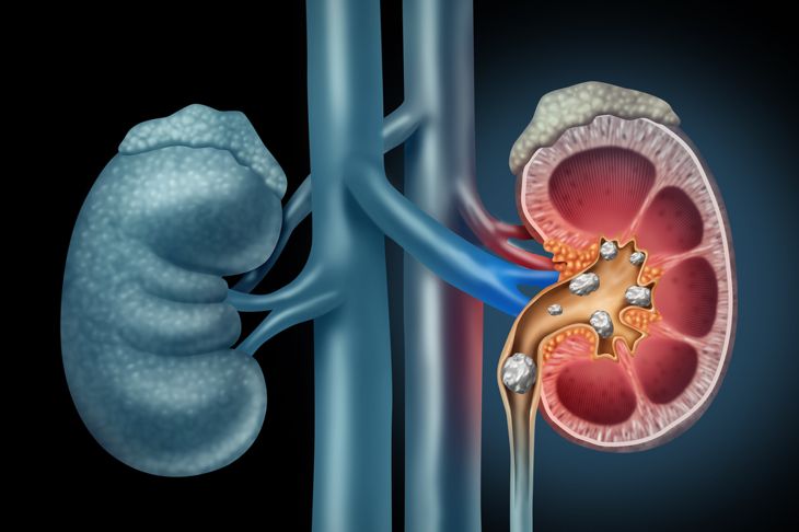 10 Signs of Kidney Stones