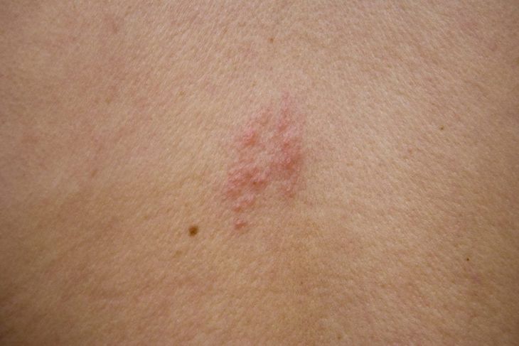 10 Signs of Shingles
