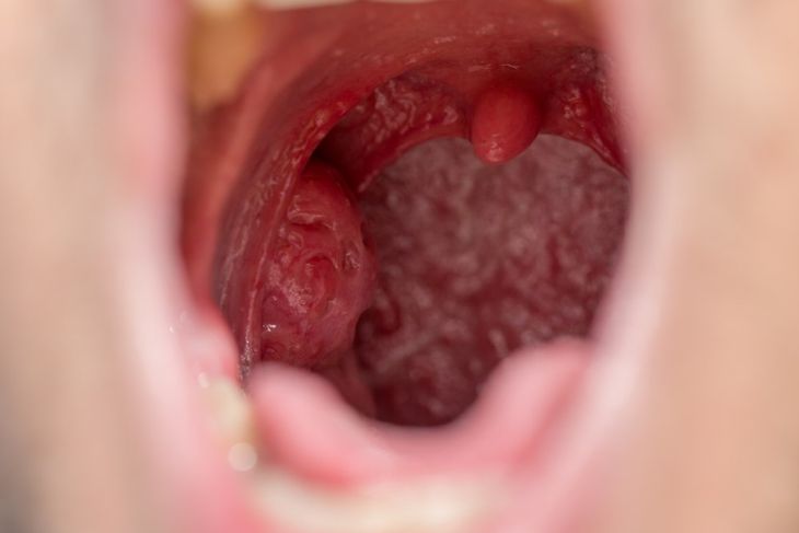 10 Signs of Strep Throat