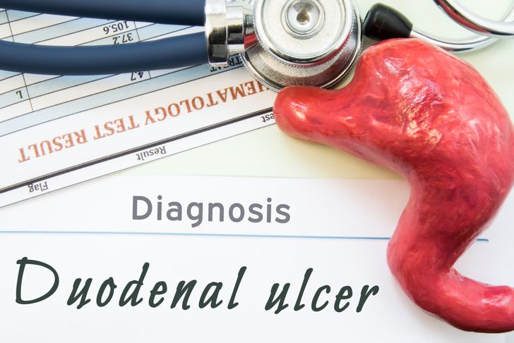 10 Symptoms and Treatments of a Duodenal Ulcer