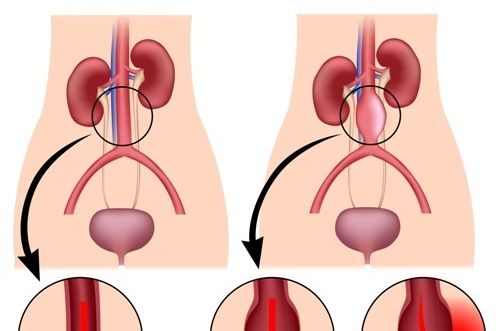 10 Symptoms and Treatments of Abdominal Aortic Aneurysm