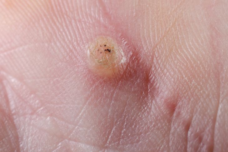 10 Symptoms and Treatments of Anal Warts