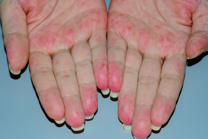 10 Symptoms and Treatments of Buerger's Disease