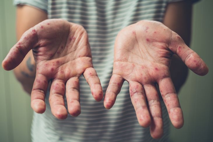 10 Symptoms and Treatments of Chilblains