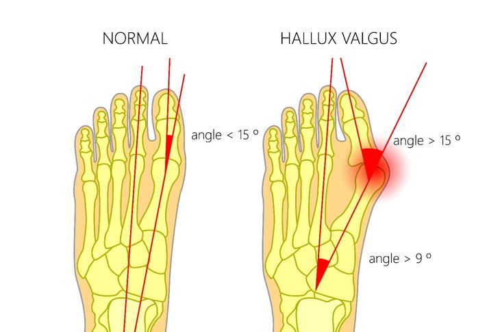 10 Symptoms and Treatments of Hallux Valgus