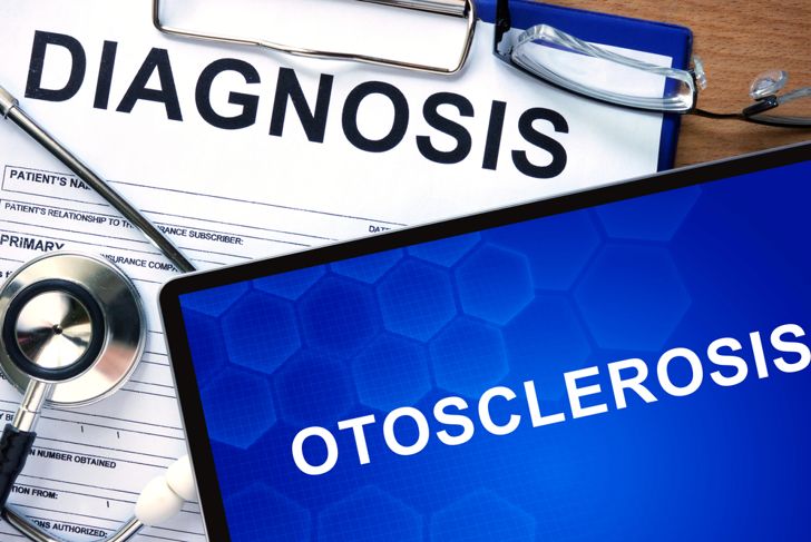 10 Symptoms and Treatments of Otosclerosis