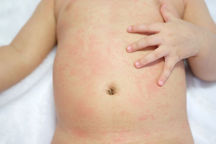 10 Symptoms and Treatments of Scarlet Fever