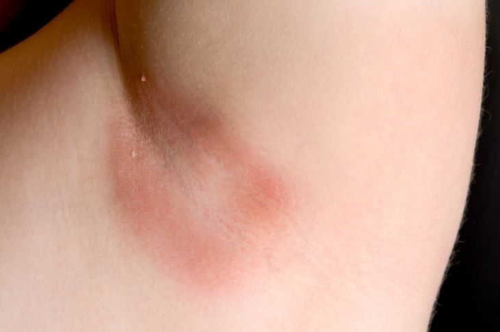 10 Symptoms and Treatments of Scarlet Fever