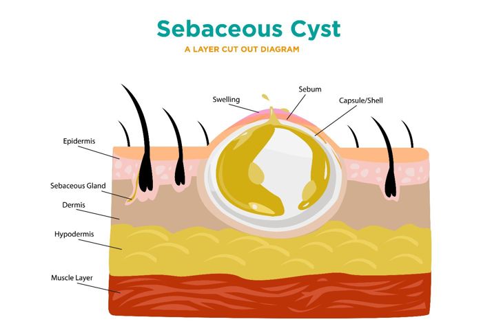 10 Symptoms and Treatments of Sebaceous Cysts