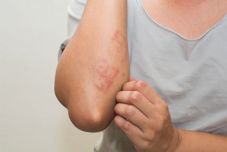 10 Symptoms and Treatments of Tick Bites