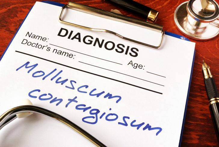 10 Symptoms, Causes, and Treatments: Molluscum Contagiosum