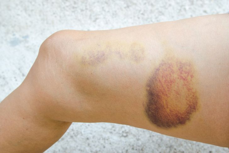 10 Symptoms of a Hamstring Injury