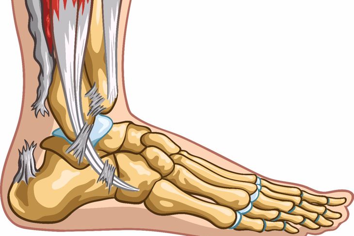 10 Symptoms of Achilles Tendon Injury