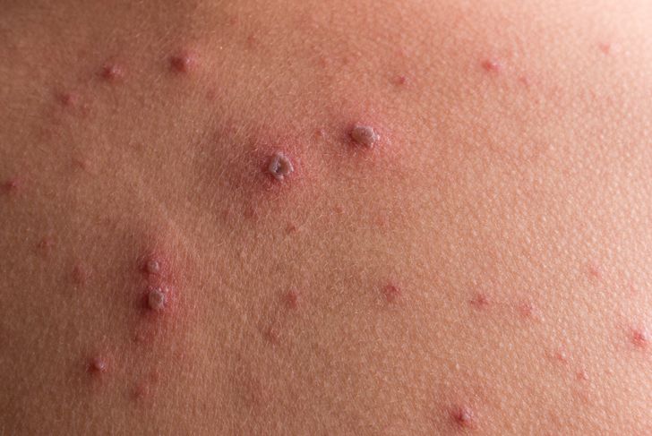 10 Symptoms of Chicken Pox