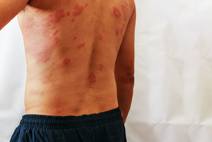 10 Symptoms of Chikungunya