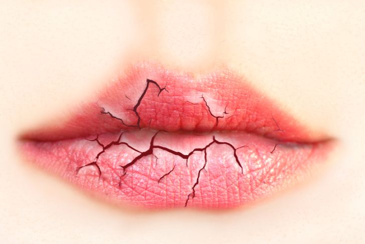 10 Symptoms of Dry Mouth