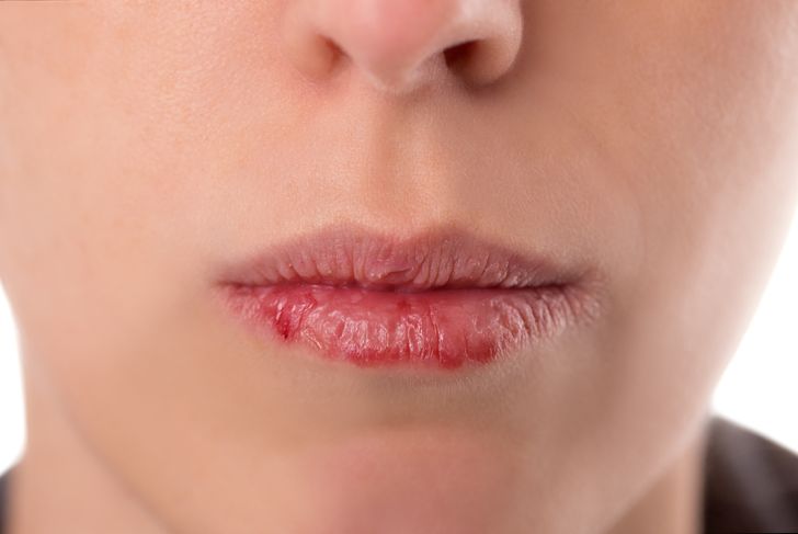 10 Symptoms of Dry Mouth