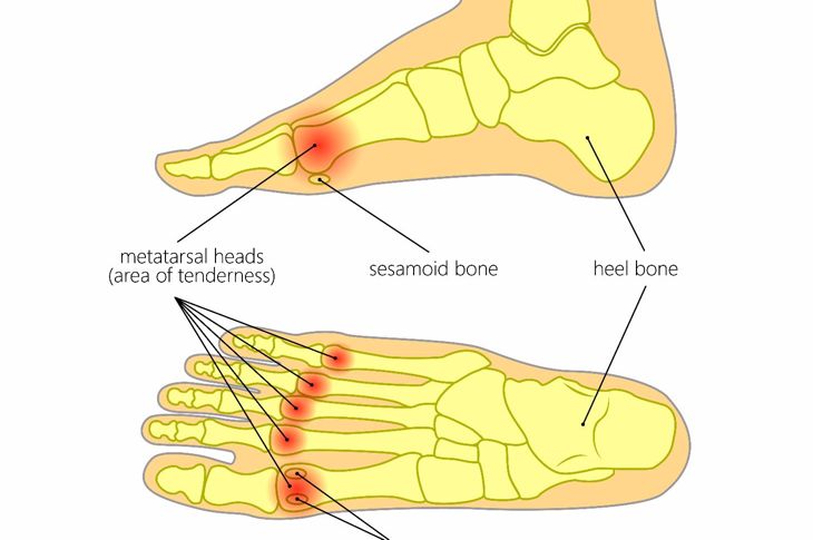 10 Symptoms of Metatarsalgia