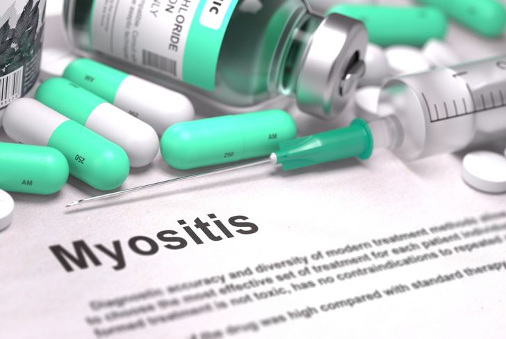 10 Symptoms of Myositis