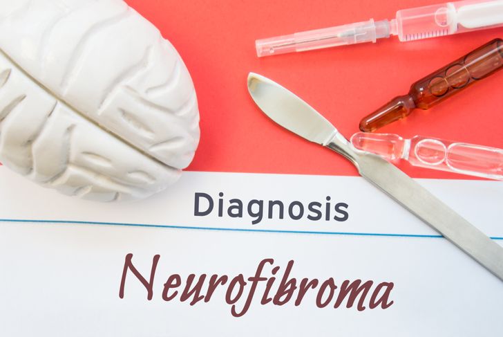 10 Symptoms of Neurofibromatosis