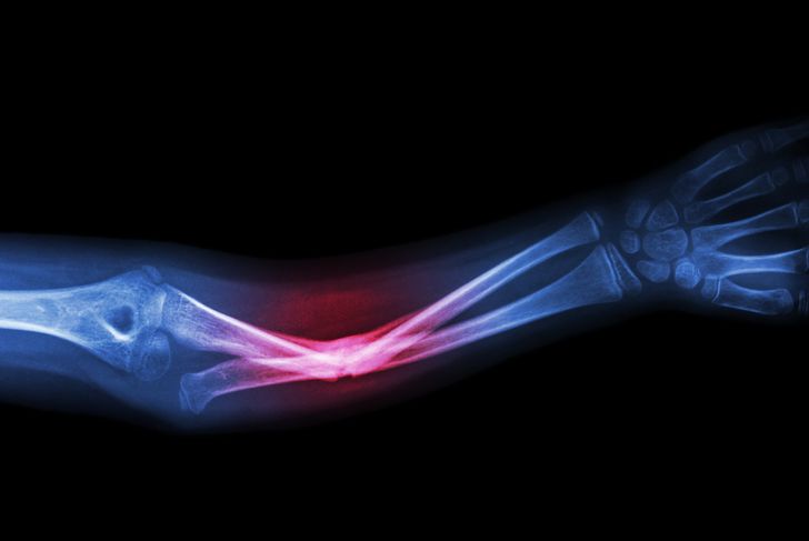 10 Symptoms of Osteosarcoma