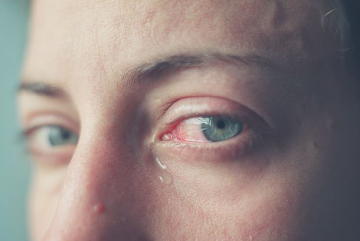 10 Symptoms of Pink Eye