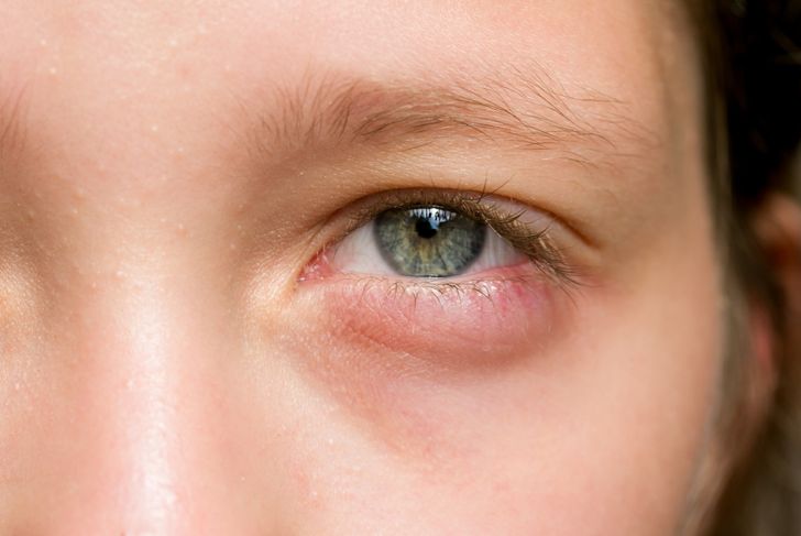 10 Symptoms of Pink Eye