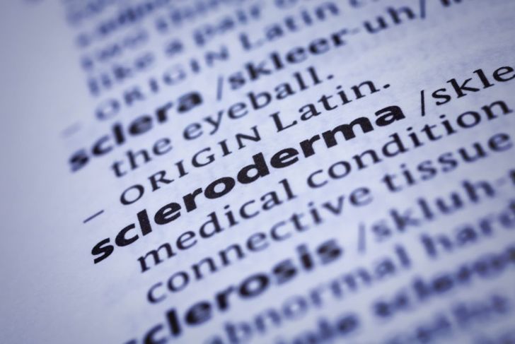 10 Symptoms of Scleroderma