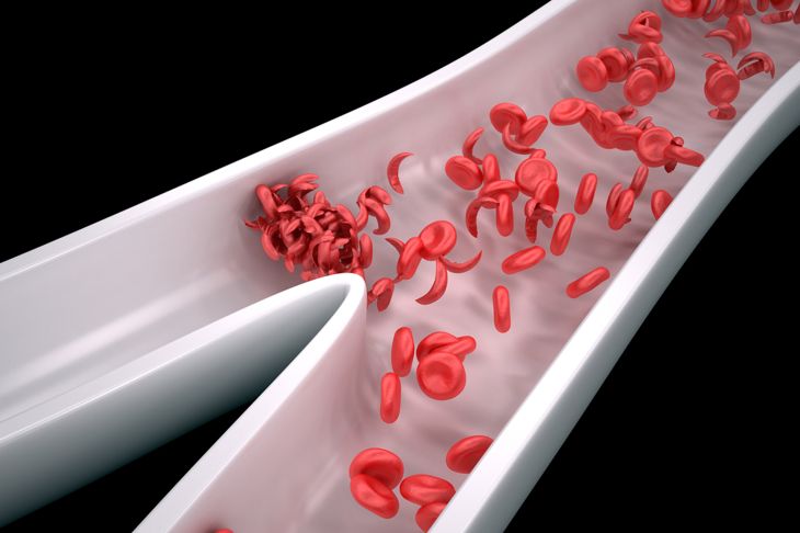 10 Symptoms of Sickle Cell Anemia
