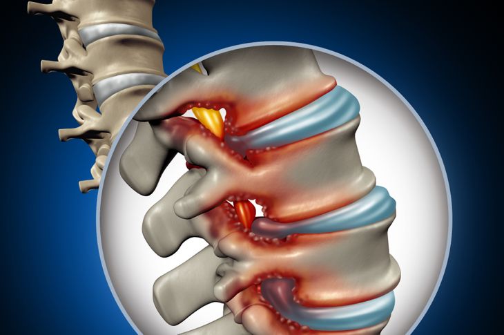 10 Symptoms of Spinal Stenosis