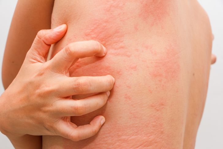 10 Symptoms of Sulfa Allergies