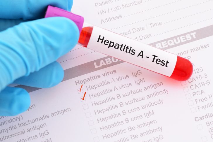 10 Things to Know About Hepatitis A (Symptoms, Causes, and More)