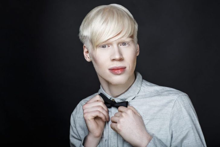 10 Things You Didn't Know About Albinism