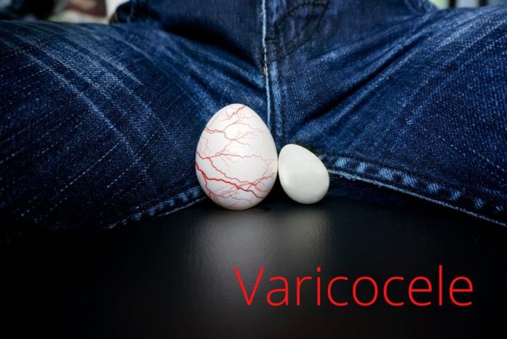 10 Things You Need to Know About Varicoceles