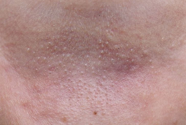 10 Types of Skin Bumps