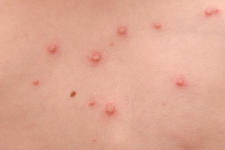 10 Types of Skin Bumps