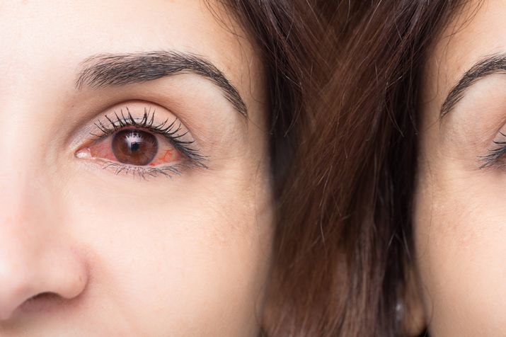13 Causes of Red Eye