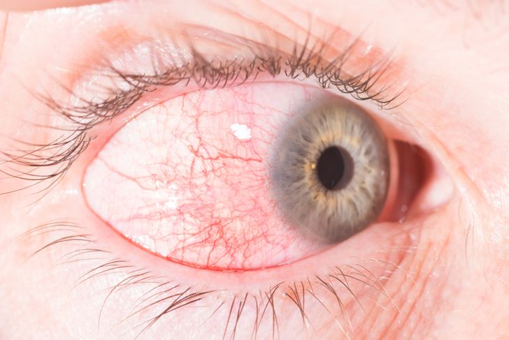 13 Causes of Red Eye