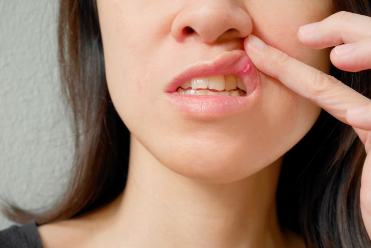 8 Causes of a Mouth Ulcer