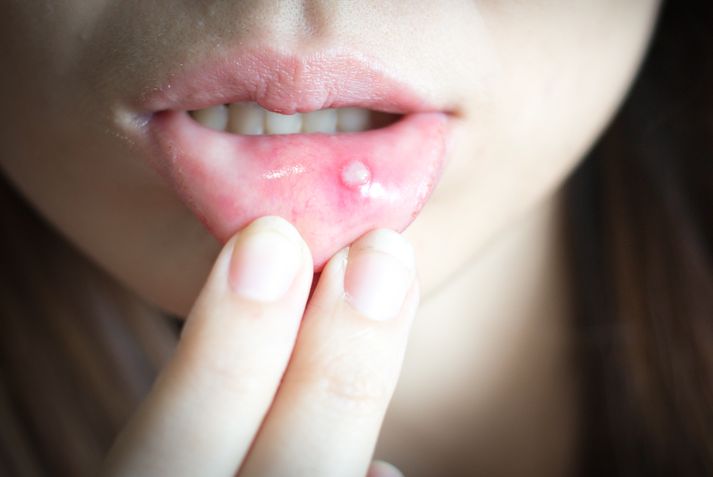 8 Causes of a Mouth Ulcer
