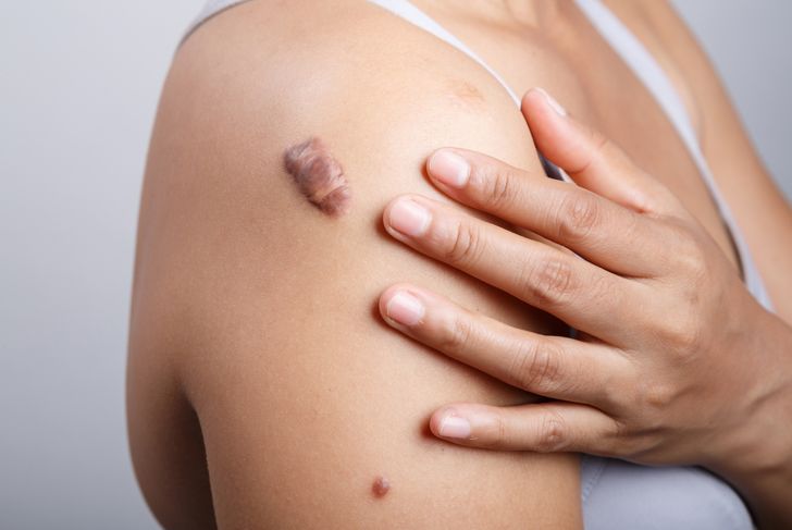 8 Symptoms and Treatments of Keloids