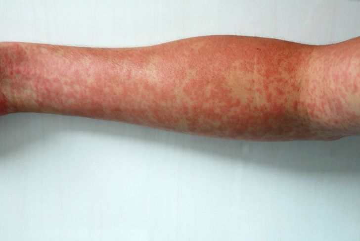 8 Symptoms of Measles