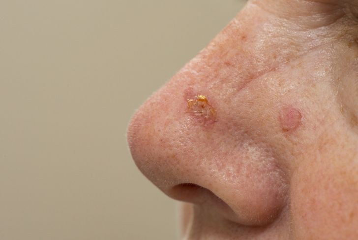 9 Symptoms and Treatments of Actinic Keratosis