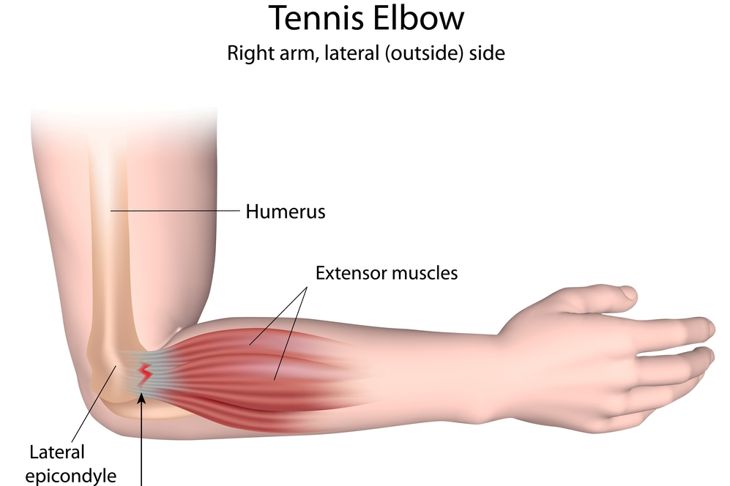 9 Treatments for Tennis Elbow