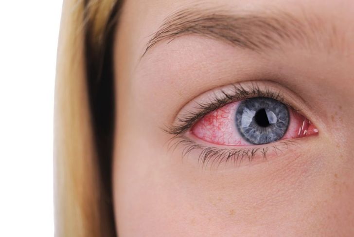 Allergic Conjunctivitis: Causes, Symptoms, and Treatments