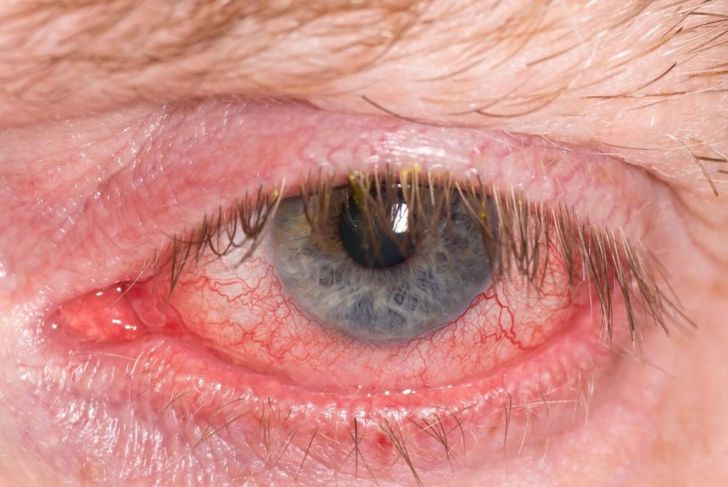 Allergic Conjunctivitis: Causes, Symptoms, and Treatments