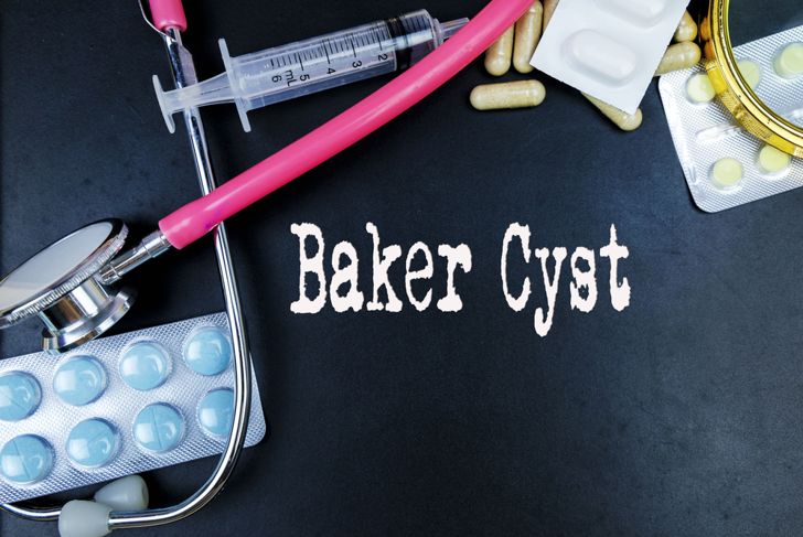 Baker’s Cyst: Symptoms and Treatments