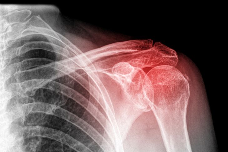 Bankart Lesions and Shoulder Instability